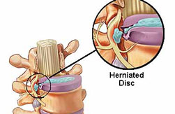Non-surgical spinal decompression Costa Mesa