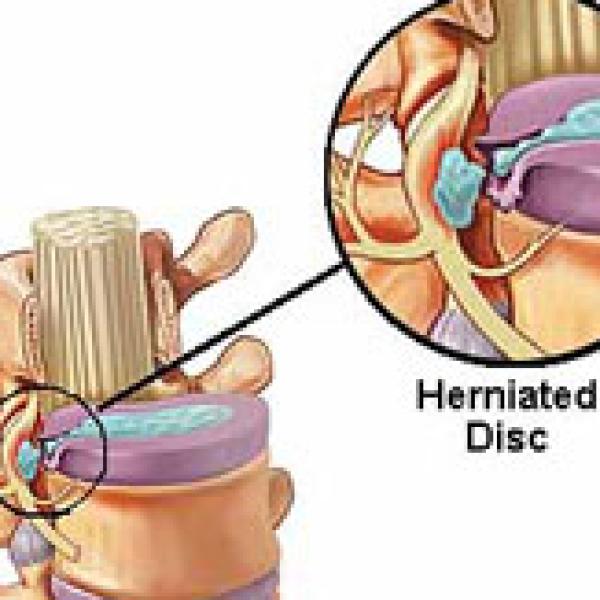 Non-surgical spinal decompression Costa Mesa